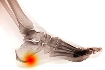 Heel spurs treatment in the Houston, TX 77095 area