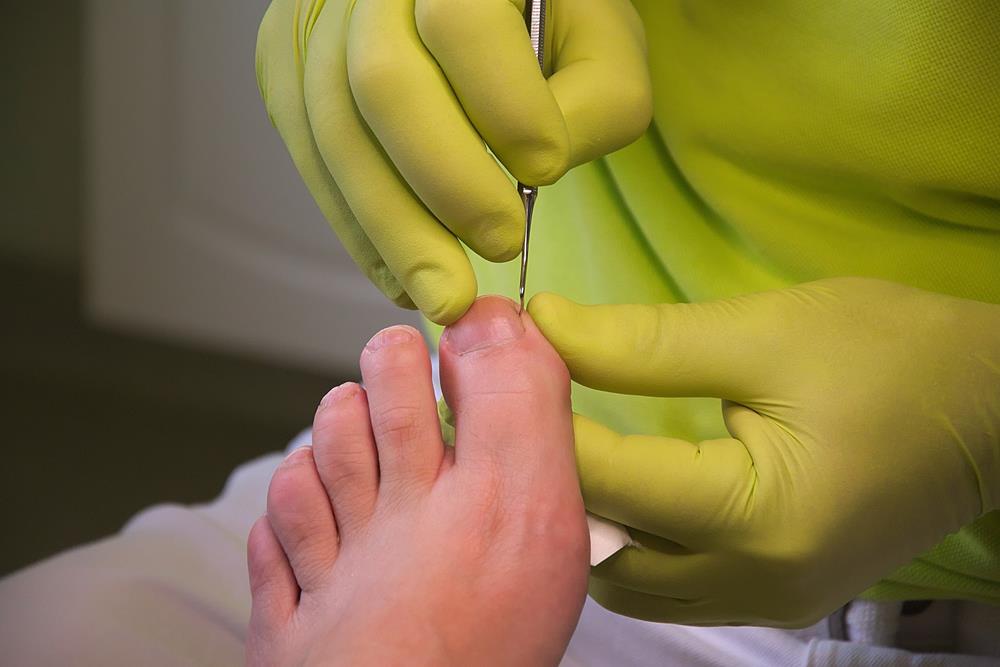 Ingrown Toenails Cypress, TX
